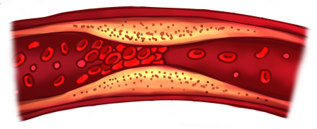 고지혈증 hyperlipidemia