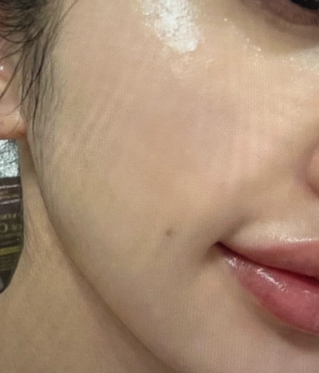 덴서티-시술-후-효과-사진