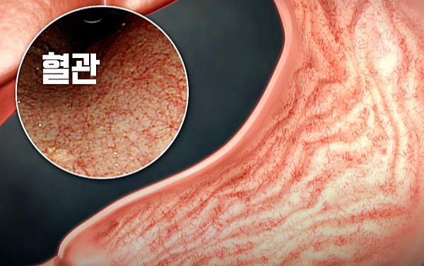 위축성 위염_출처:명의유튜브1