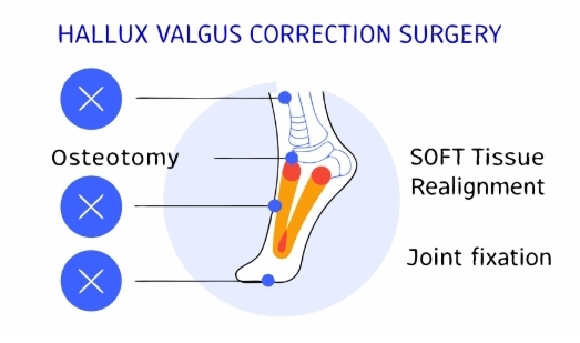 무지외반증 수술 과정