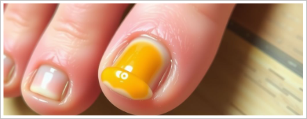 발톱무좀을 방치하면 생기는 문제