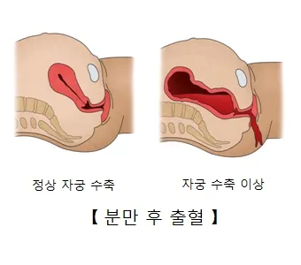 출산 후 자궁수축 기간_5