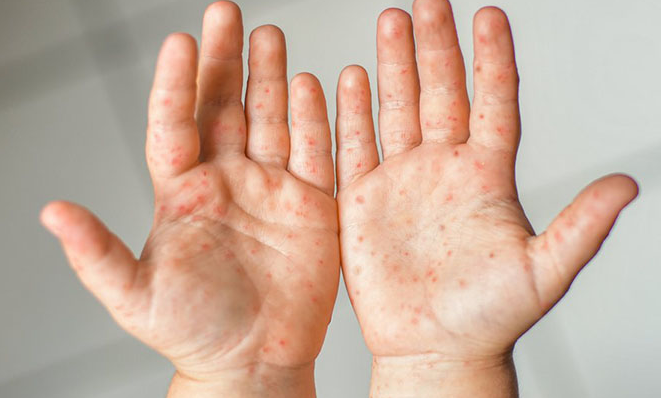 여름철 유행하는 수족구병: 의심증상, 치료방법 및 예방방법