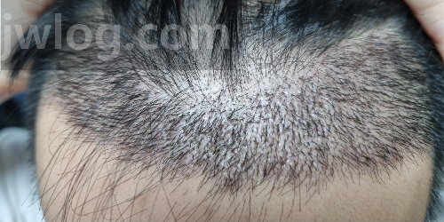 모발이식 17일차
