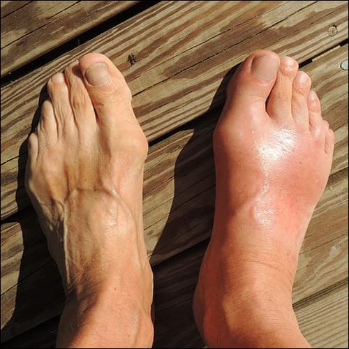 오른발에 통풍이 있는 모습