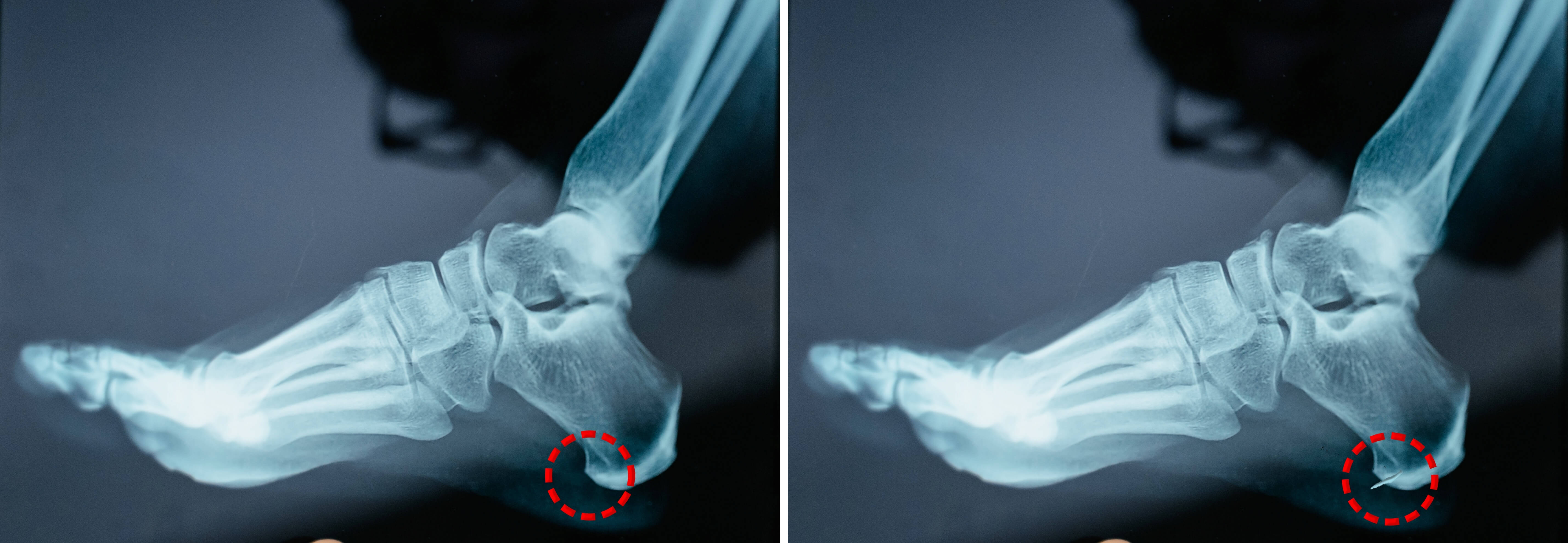 왼쪽 엑스레이발 뒤꿈치 붉은 점선 동그라미
오른쪽 엑스레이발 뼈가 튀어나온 발 뒤꿈치 붉은 점선 동그라미