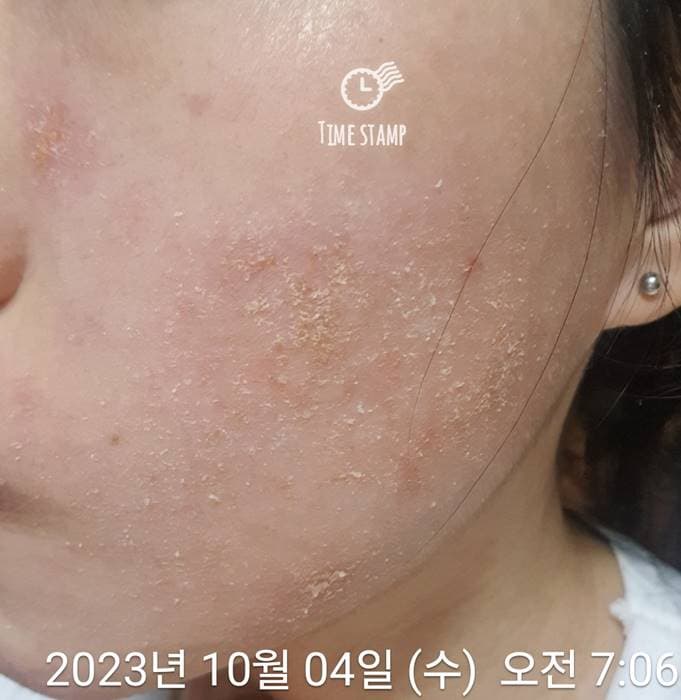 얼굴 피부염