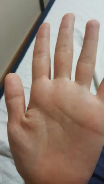 수족구 어른 전염에 대한 원인과 예방법 정리_13