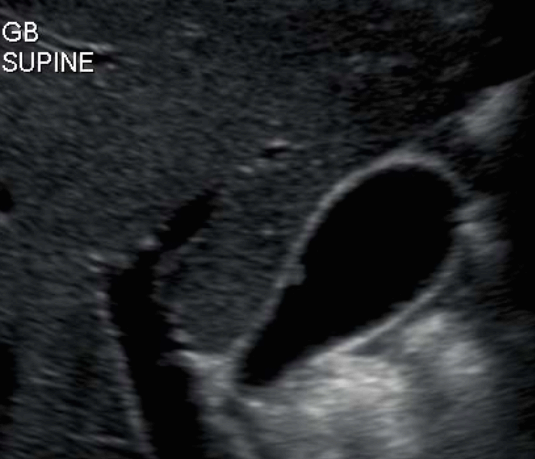 담낭 용종 ( GB polyp )