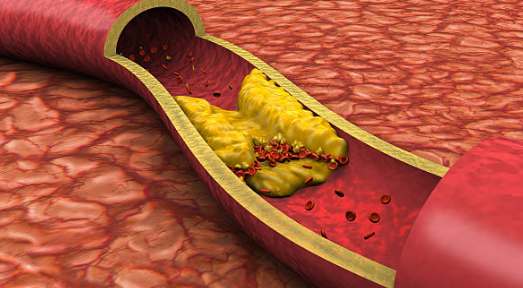 고지혈증 증상&amp;#44; 고지혈증에 좋은 음식&amp;#44; 고지혈증 수치 총정리 (2024ver)