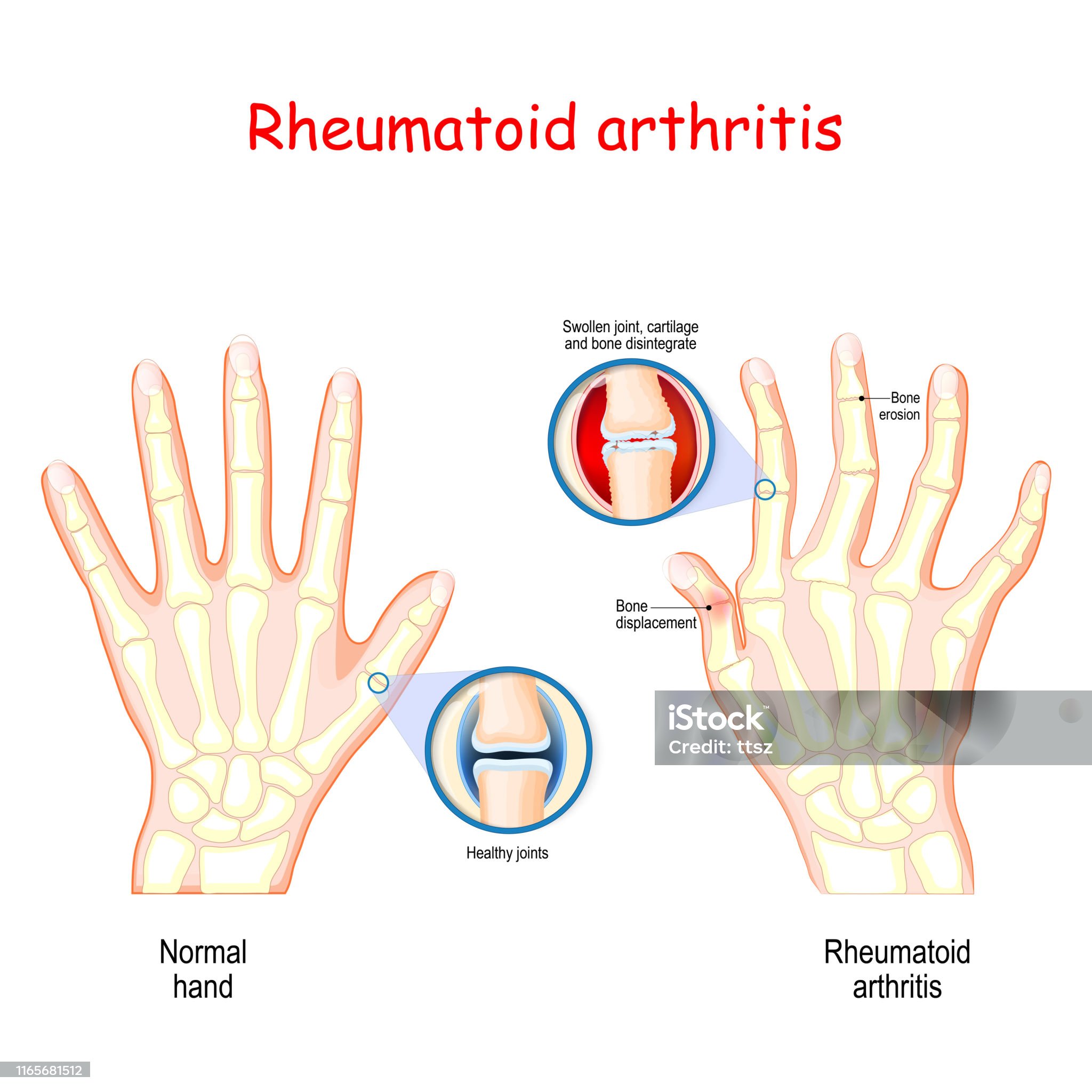류마티스 관절염