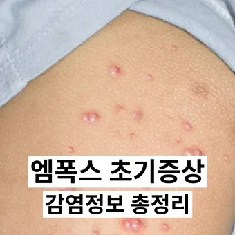 엠폭스 증상 예방접종 대처법 치료방법_6