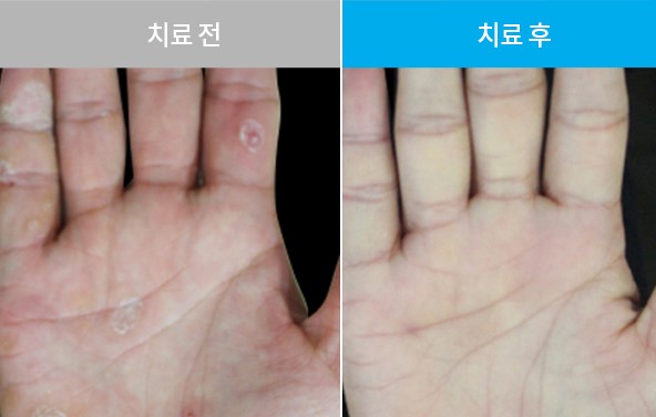 피부병 치료, 한의학적 치료사례