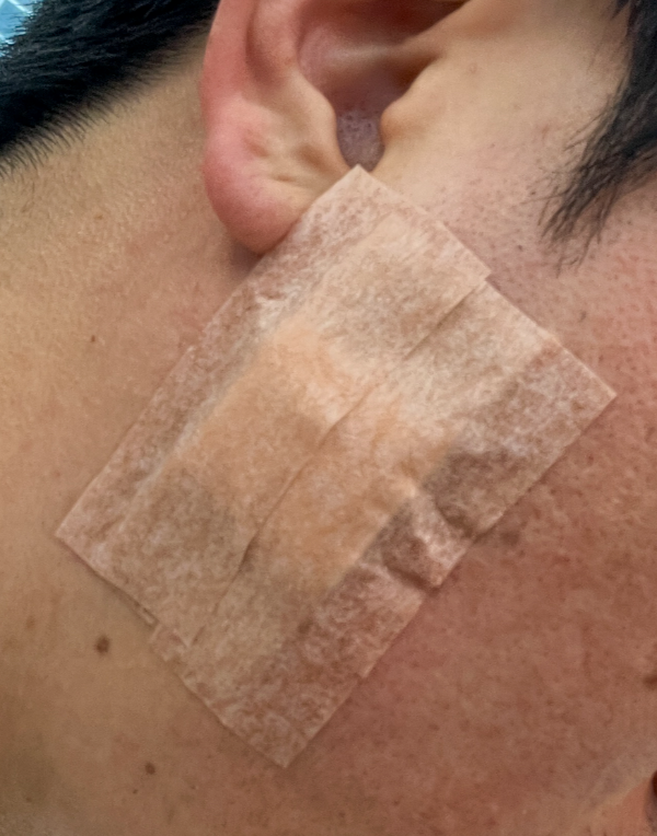 종기-치료후-사진