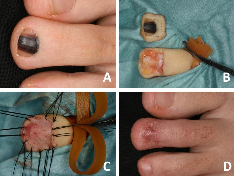 발톱-흑색종-초기-증상-치료-사진