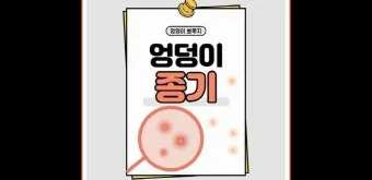 엉덩이 종기가 생기는 이유 왜 생기고 어떻게 관리할까요 완벽 가이드_18