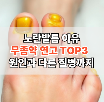 노란발톱-이유-무좀약-연고-추천