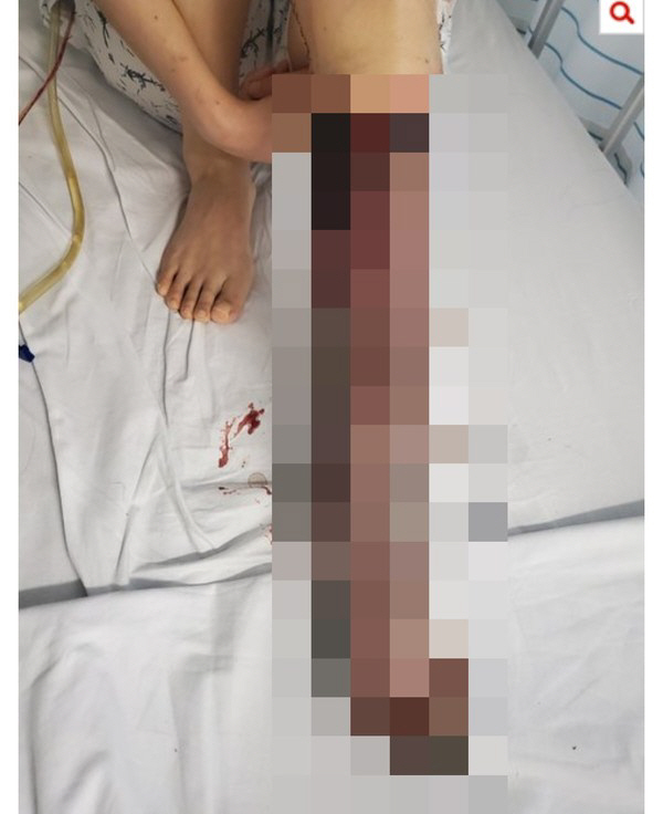 미 FDA, 얀센 백신 이제서야 혈전 위험 경고...'혈소판 감소성 혈전증'(TTS) 부작용 COVID-19 Vaccines: With Narrowed Authorization For Janssen, US FDA Catches Up To CDC