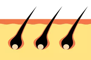 모발이식-3000모-비용