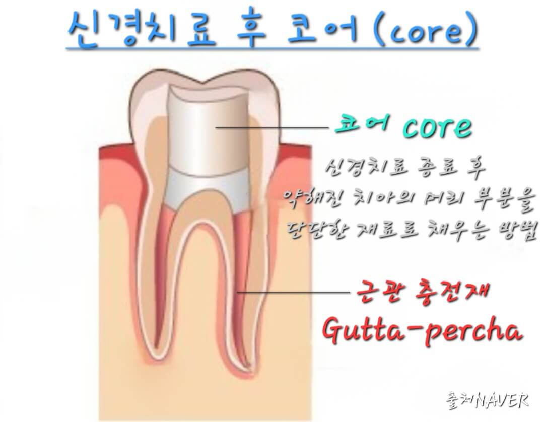 신경치료후코어