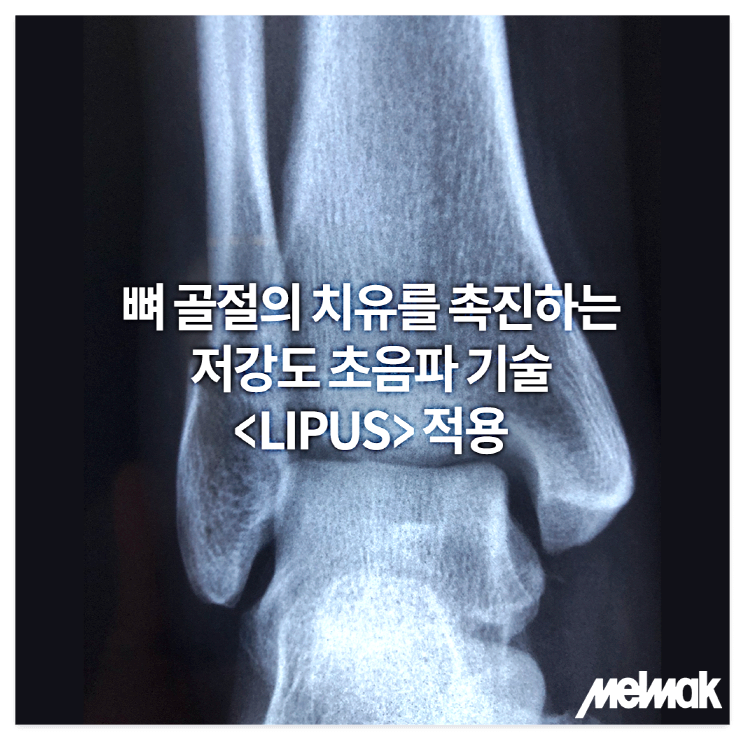 골절 재활의 혁신: 멜막(MelMak) 초음파 치료기로 빠른 회복!