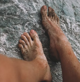 무좀 치료법 예방법 진단기준