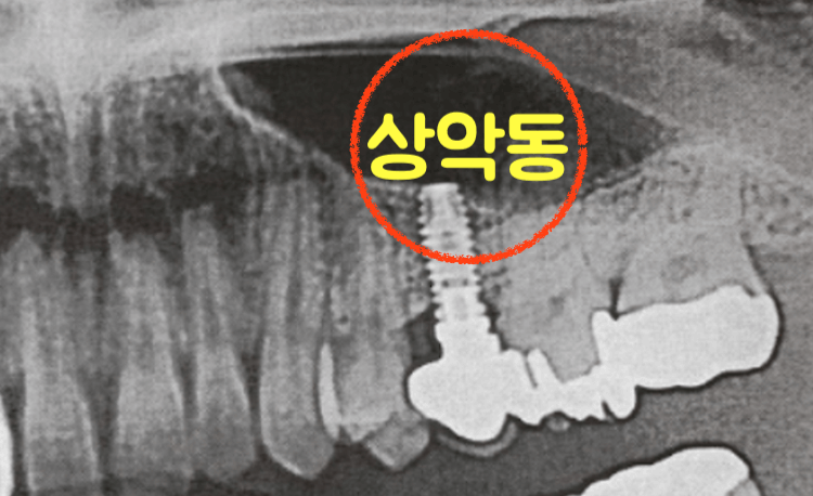 상악동