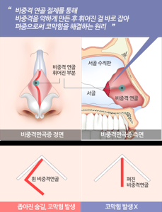 비중격 만곡증