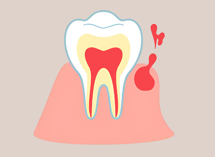 잇몸-출혈-모습