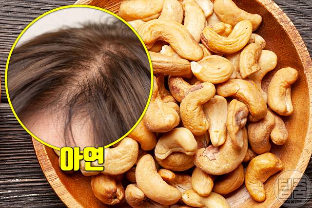 탈모 비타민 아연 음식 탈모에좋은비타민