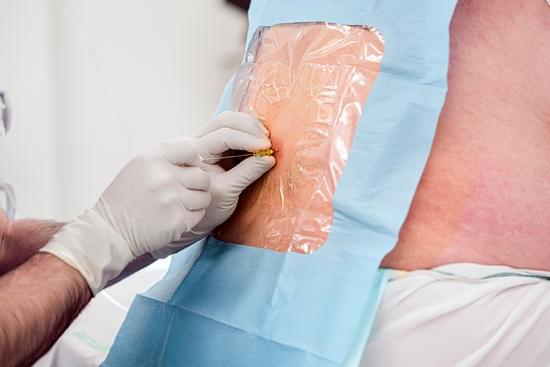 경막외 신경 차단술 (Epidural Nerve Block)