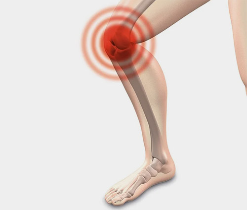 류마티스관절염