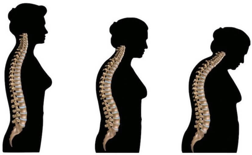 노화에 따른 근골격계 변화