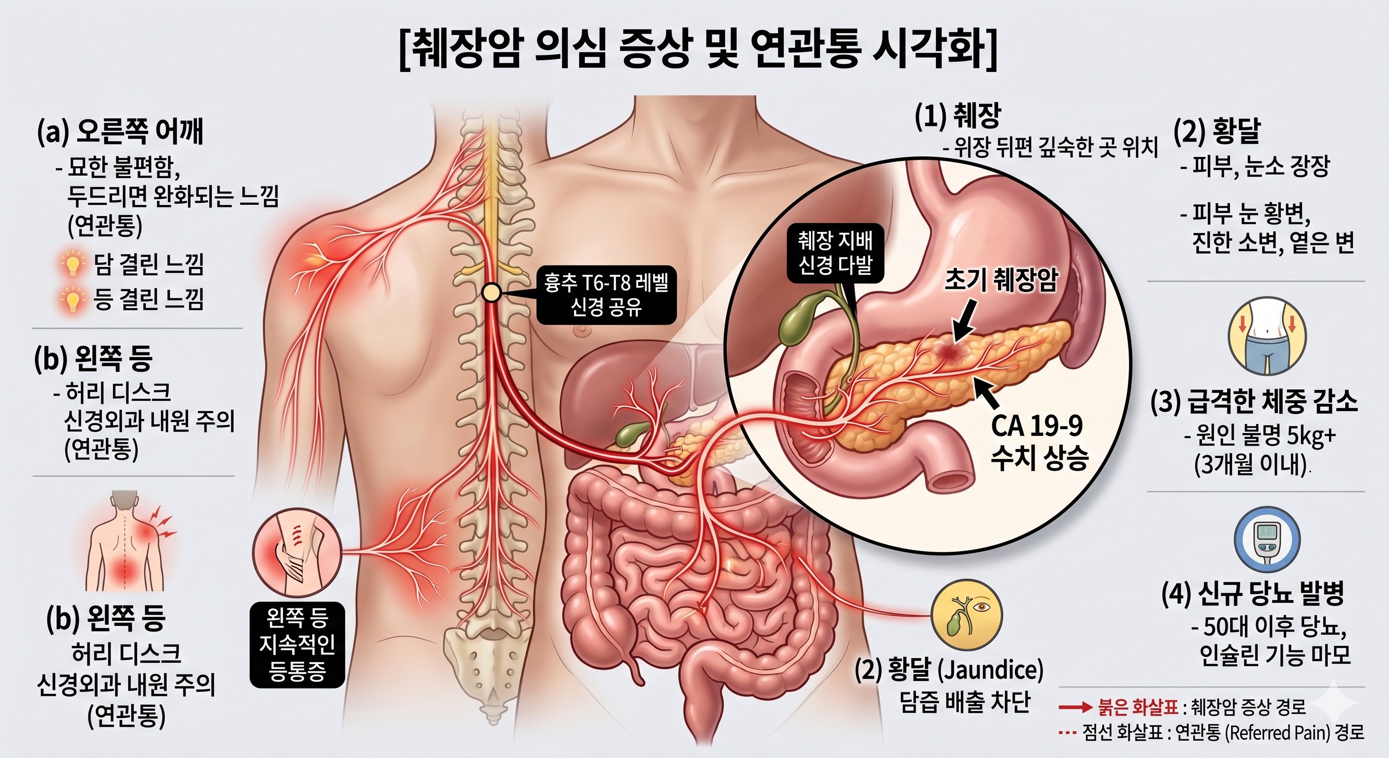 췌장에서 등/어깨로 연결되는 신경 신호를 보여주는 이미지
이이지출처: Gemini AI 생성