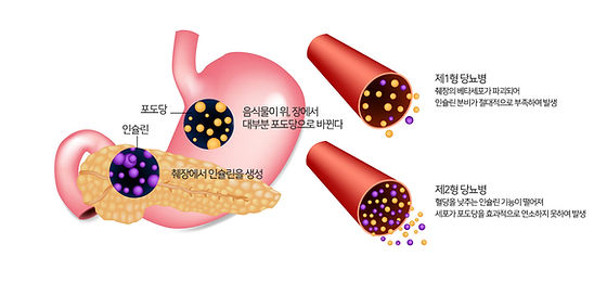 당뇨병 초기증상과 예방방법