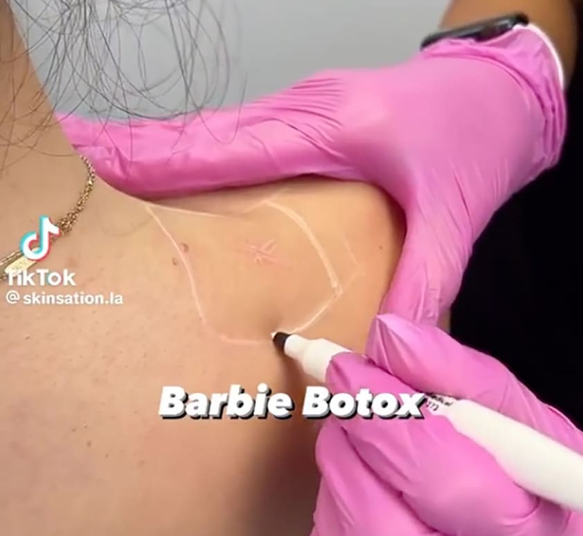 요즘 유행하는 '바비 보톡스'란 VIDEO: What is ‘Barbie Botox,’ TikTok’s latest beauty obsession?