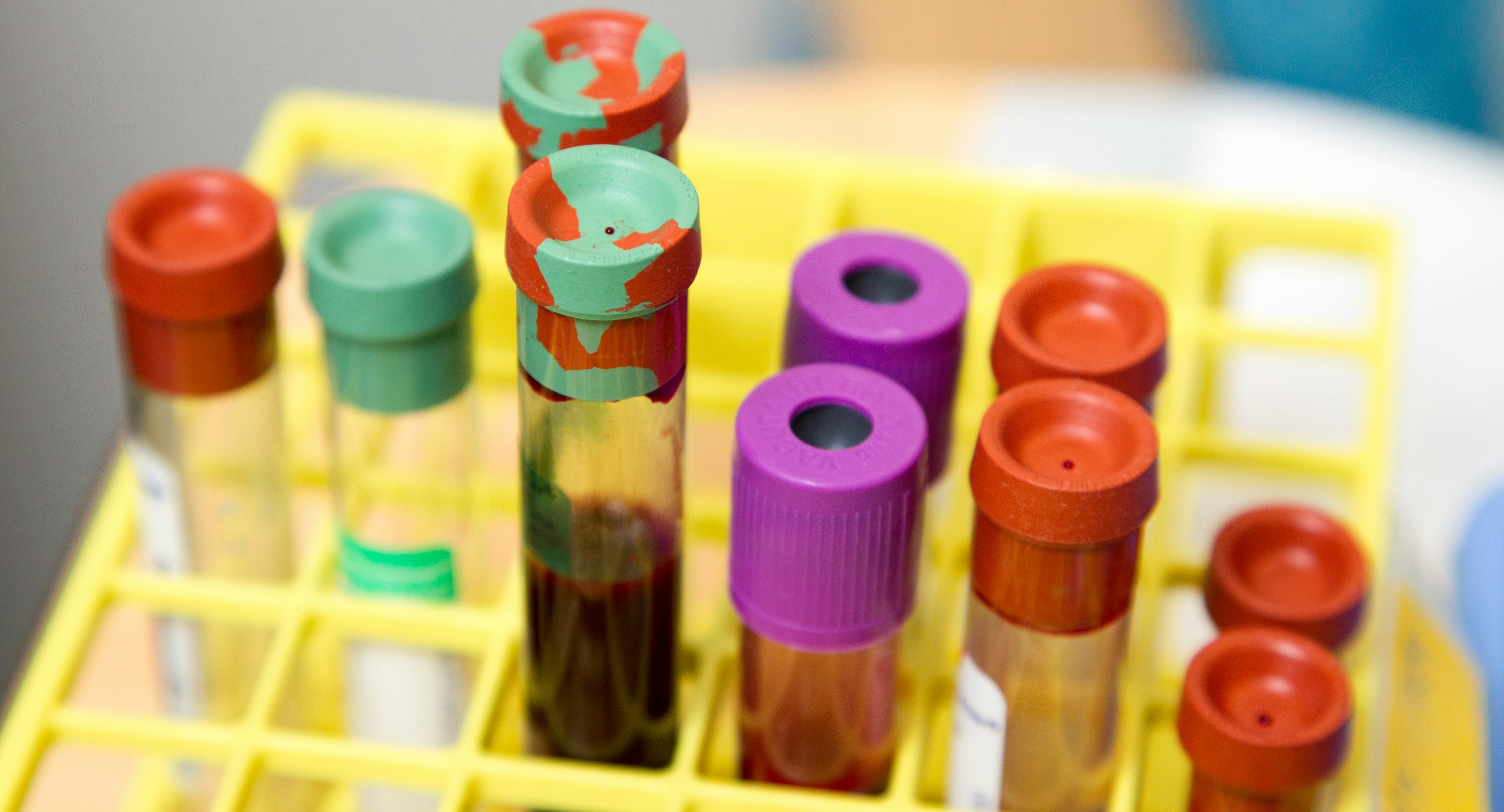 혈액이 담긴 혈액검사병