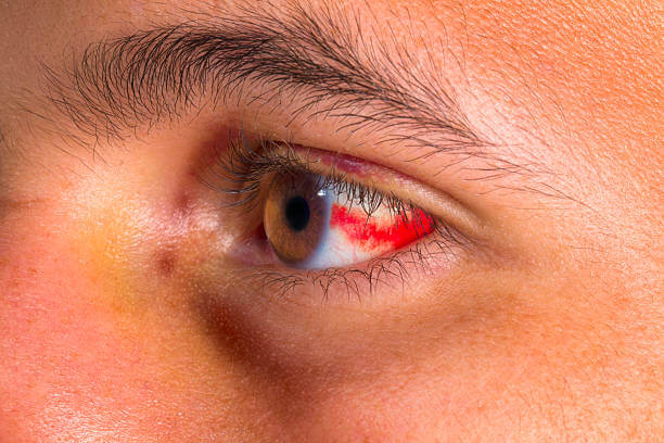 눈 실핏줄 터짐 원인 9가지 및 치료방법. 눈 실핏줄 터짐&amp;#44; 눈의 조직과 혈관의 손상으로 인해 발생하는 현상으로&amp;#44; 여러 요인에 의해 유발될 수 있습니다. 이 문제는 안구 건강을 반영하며&amp;#44; 원인을 파악하고 적절한 치료 및 예방책을 찾는 것이 중요합니다.