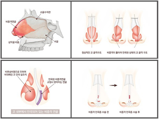 비중격 교정술 증상 및 진단 방법