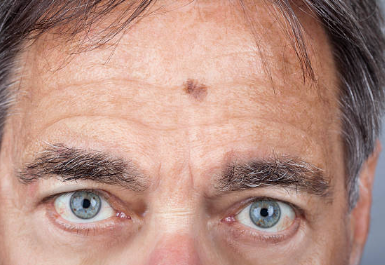 피부노화 검버섯