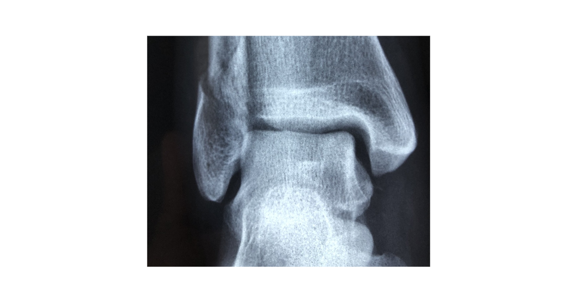 퇴행성 발목관절염