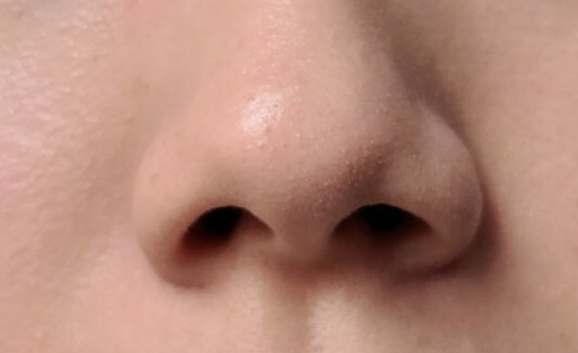 코조각주사 후기