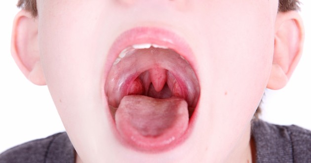 편도염 빨리 낫는 법