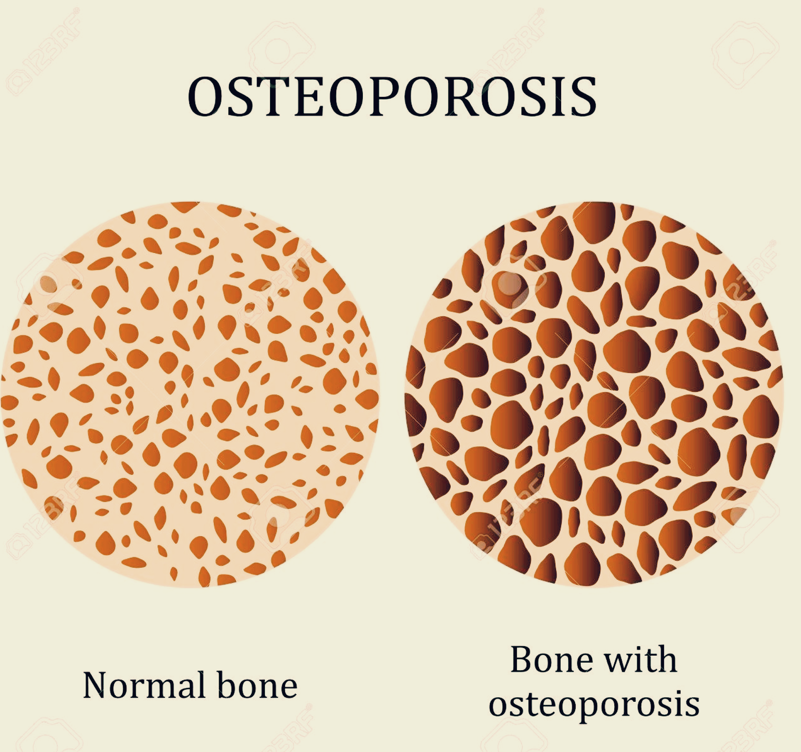 골다공증 정상과 골다공증 비교