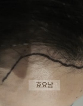 모발이식 가이드-좌