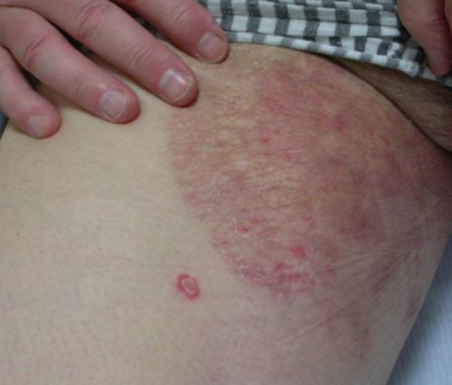 음낭 부위가 축축하고 가려움-동의보감 생식기