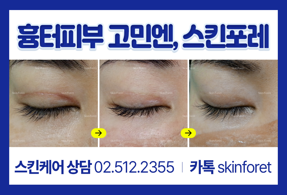 앞트임 흉살 및 흉터 피부 케어 사례
