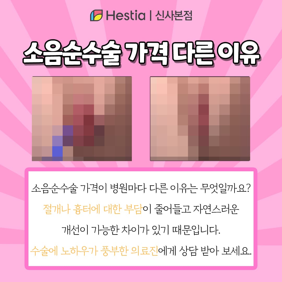 소음순수술 가격 소음순늘어짐 소음순수술 가격 다른 이유