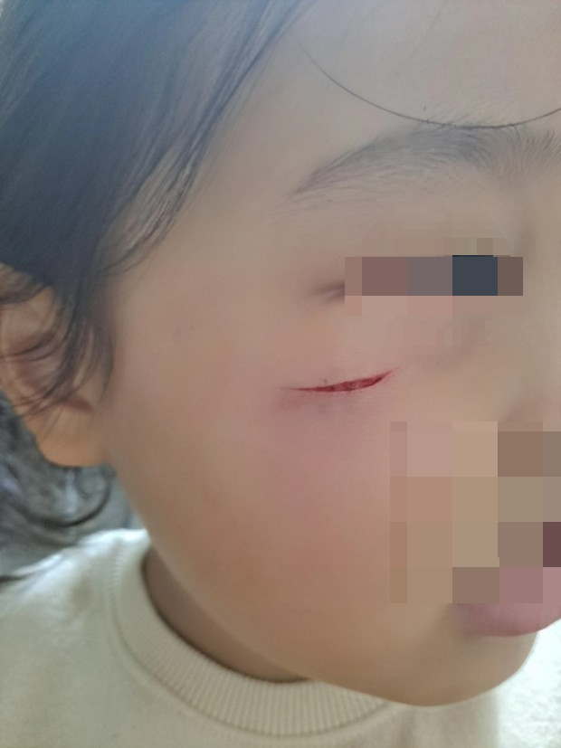 상처쉬운 치료방법과 관리: 수술 상처, 다친 상처, 흉터관리