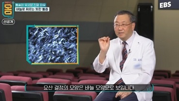요산결정